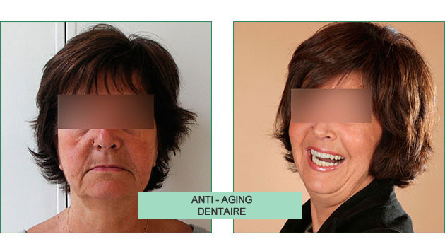 cas clinique monique anti-aging dentaire