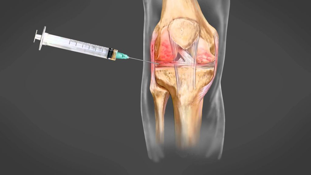 PRP genoux orthopedie