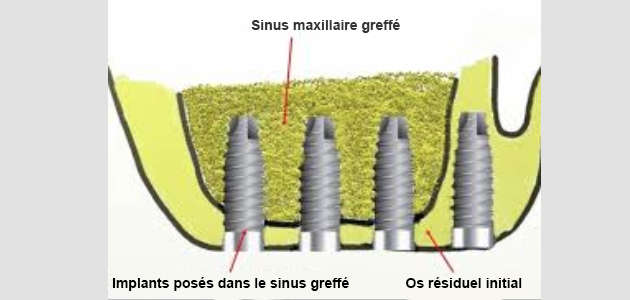 sinus lift - greffes osseuses - comblement de sinus - greffe pré-implantaire