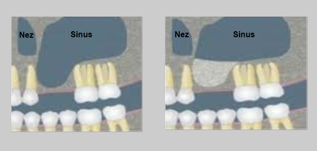 sinus lift - greffes osseuses - comblement de sinus - greffe pré-implantaire