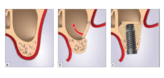 Sinus : définition et schéma (frontal, maxillaire)