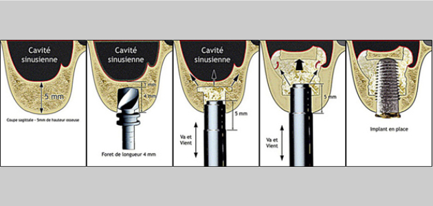 sinus lift greffes osseuses - comblement de sinus - greffe pré-implantaire