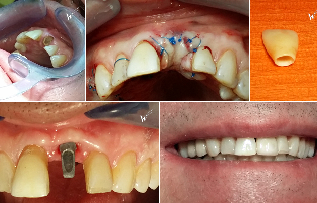 Remplacement d'une dent du sourire comme un incisive centrale par un implant dentaire et une couronne cosmétique