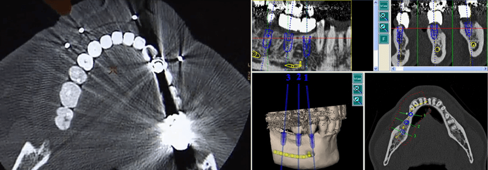 chirurgie guidée Robodent