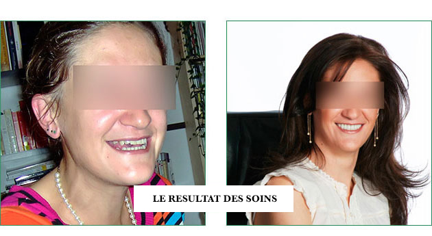 facettes céramiques sur dents du sourire