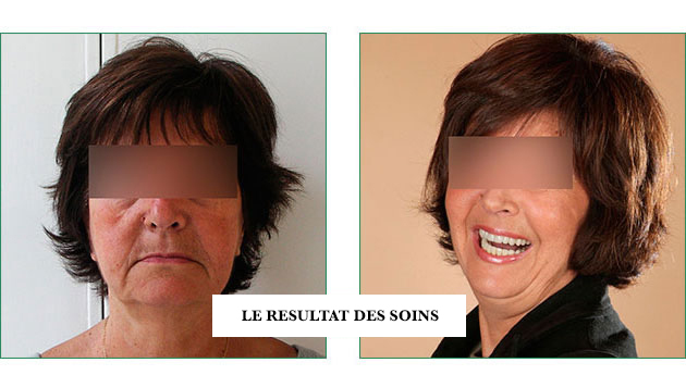 anti âge facettes céramiques
