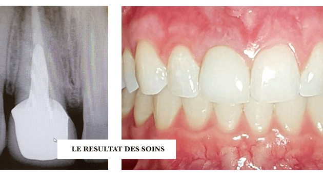 Couronne dentaire en Céramique (tout savoir sur ces prothèses)Dr Jérôme  Weinman chirurgien-dentiste Paris & médecin-dentiste Genève