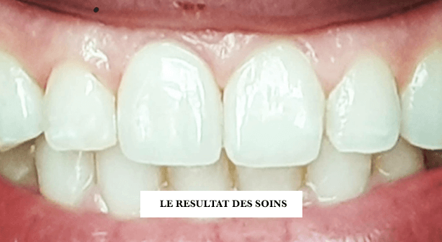 Couronne dentaire en Céramique (tout savoir sur ces prothèses)Dr Jérôme  Weinman chirurgien-dentiste Paris & médecin-dentiste Genève