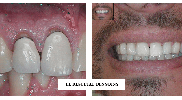 Ciment Dentaire, Colle Dentaire Pour Couronne Bridge Dent sur Pivot, Qualit