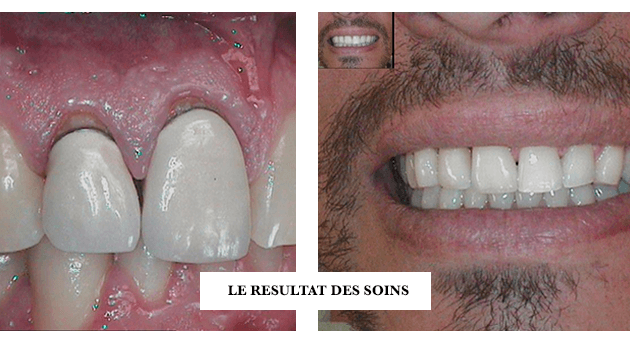 Couronne dentaire en Céramique (tout savoir sur ces prothèses)Dr Jérôme  Weinman chirurgien-dentiste Paris & médecin-dentiste Genève