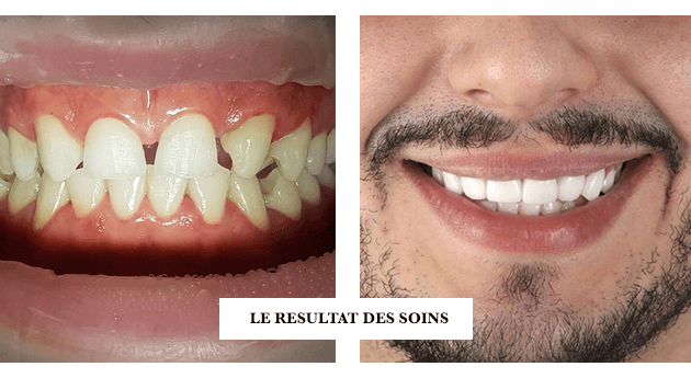 Facette dentaire - DENTAL WAY - Centres de santé dentaire