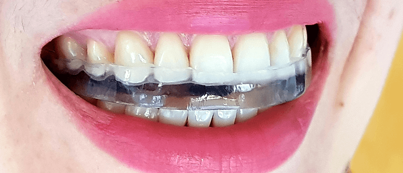 Bruxisme, grincement des dents : nos solutions pour le traiter