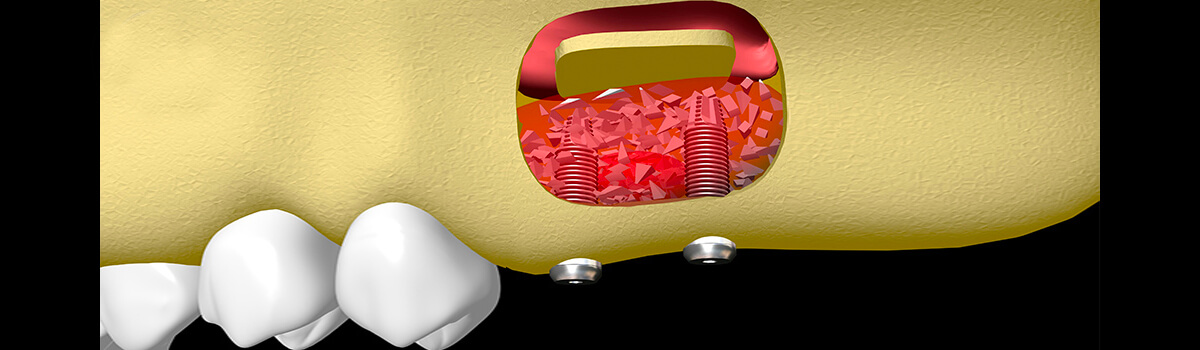 dent manquante: la solution d'un implant dentaire greffes osseuses 