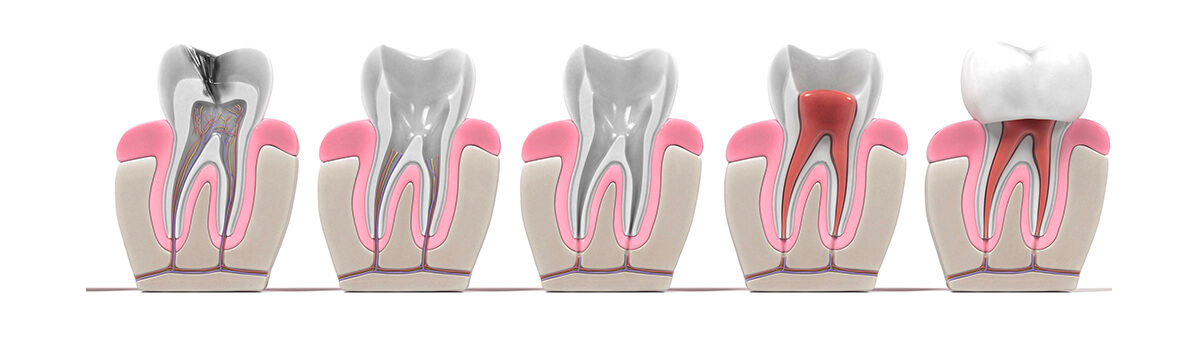 endodontie dévitalisation des dents