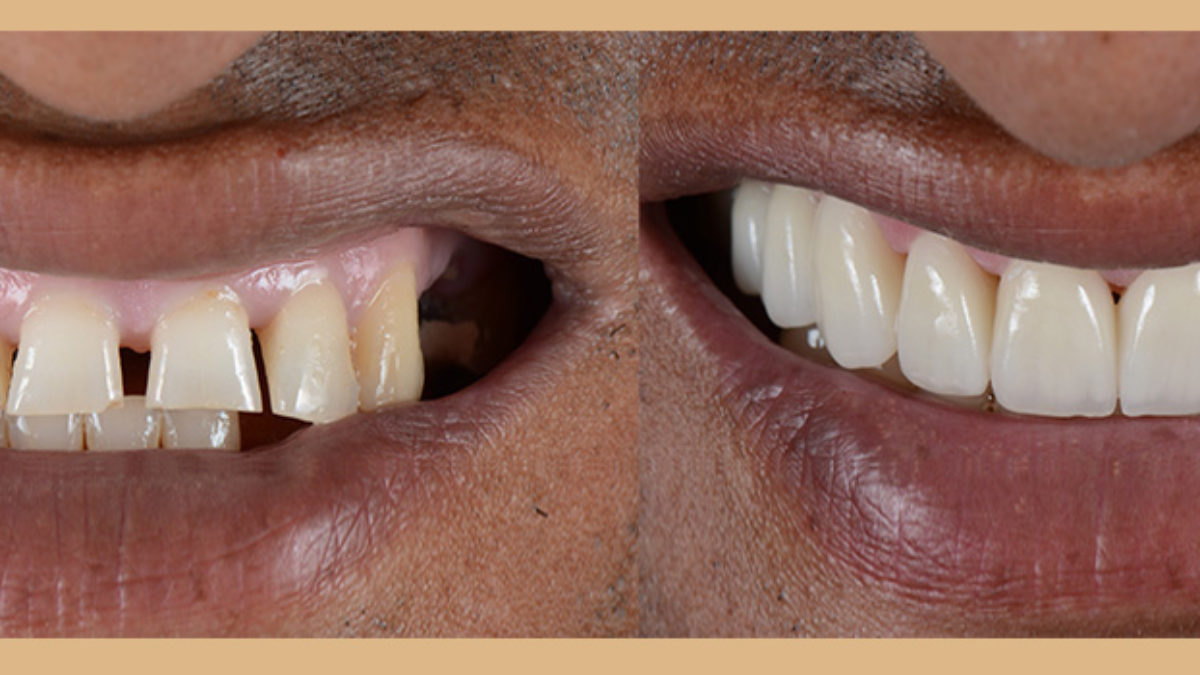 Peut On Blanchir Des Fausses Dents En Ceramique