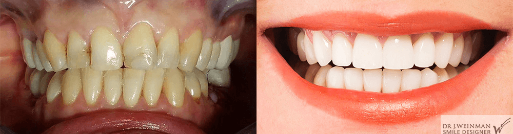 Facettes dentaires céramiques à Paris, Genève | Dr Weinman