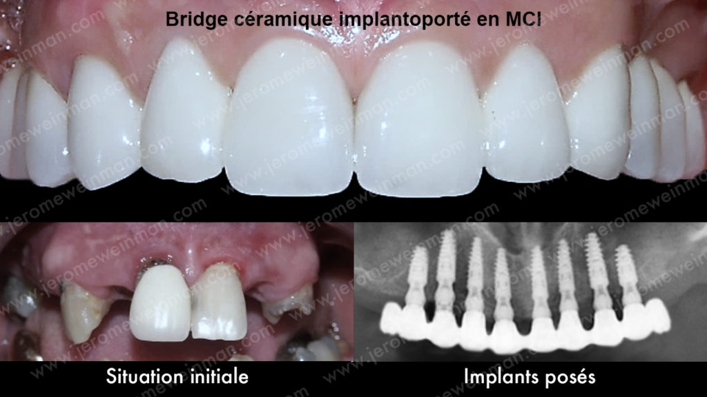 Protège dents - Laboratoire de prothèses dentaires Crown Ceram