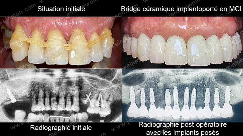 Mise en charge immédiate des implants dentaires prothèse cosmétique implanto-portée nouveau sourire