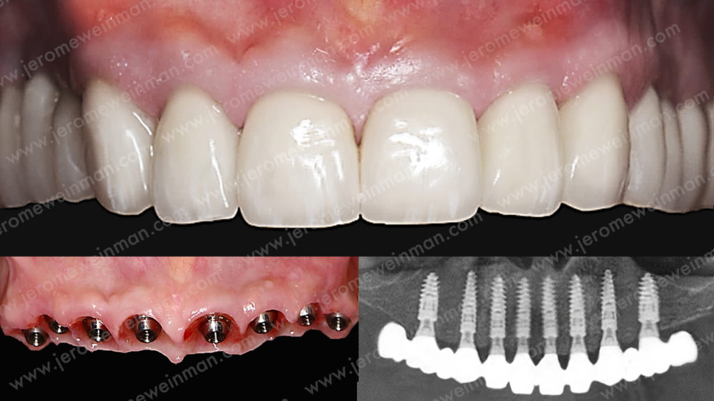 mise en charge immédiate ou MCI bridge implantoporté extraction implantation mise en charge immédiate des implants dentaires