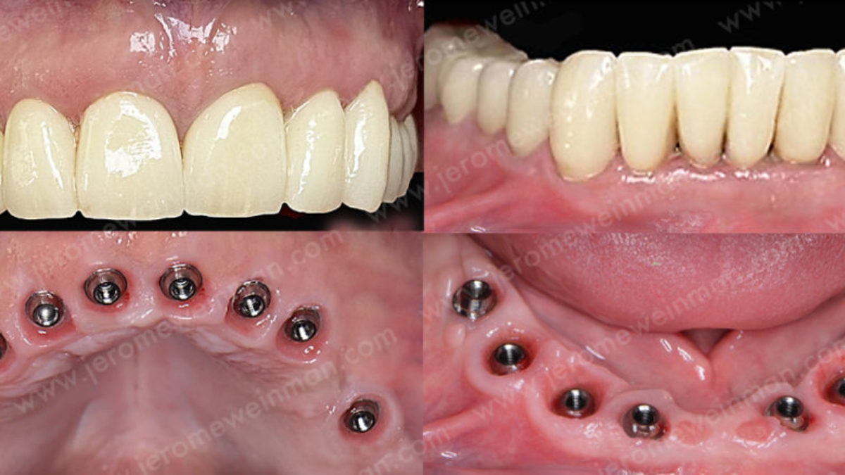 Peut On Blanchir Des Fausses Dents En Ceramique Remplacer toutes ses dents sans douleur - Édentation complète