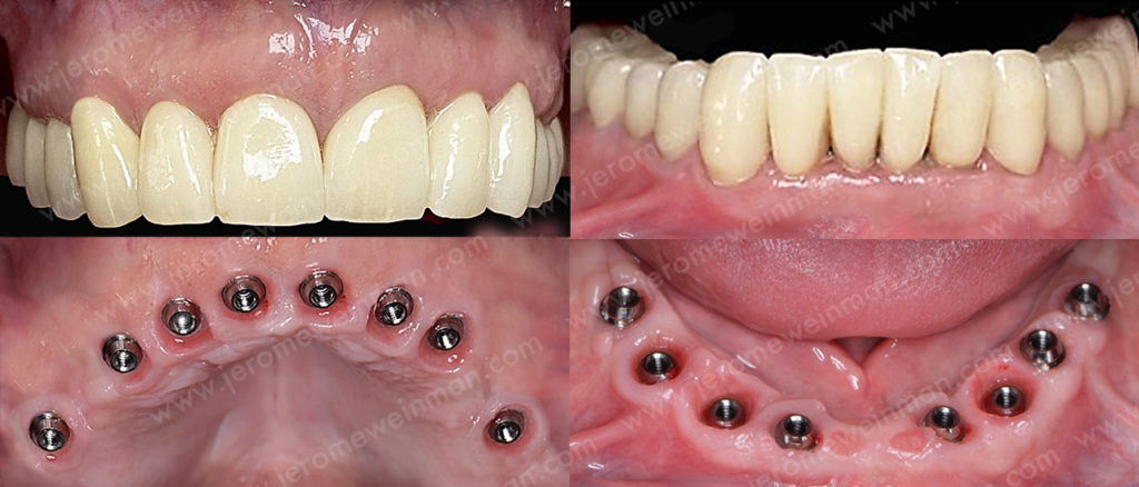 Charge immédiate sur implant dentaire - Des dents provisoires directement