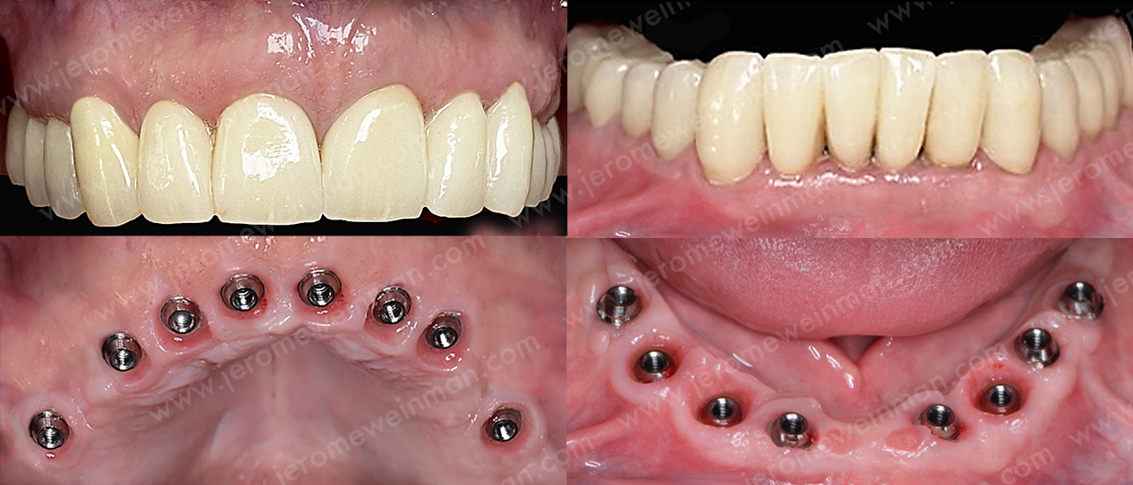 Remplacer toutes ses dents sans douleur - Édentation complète