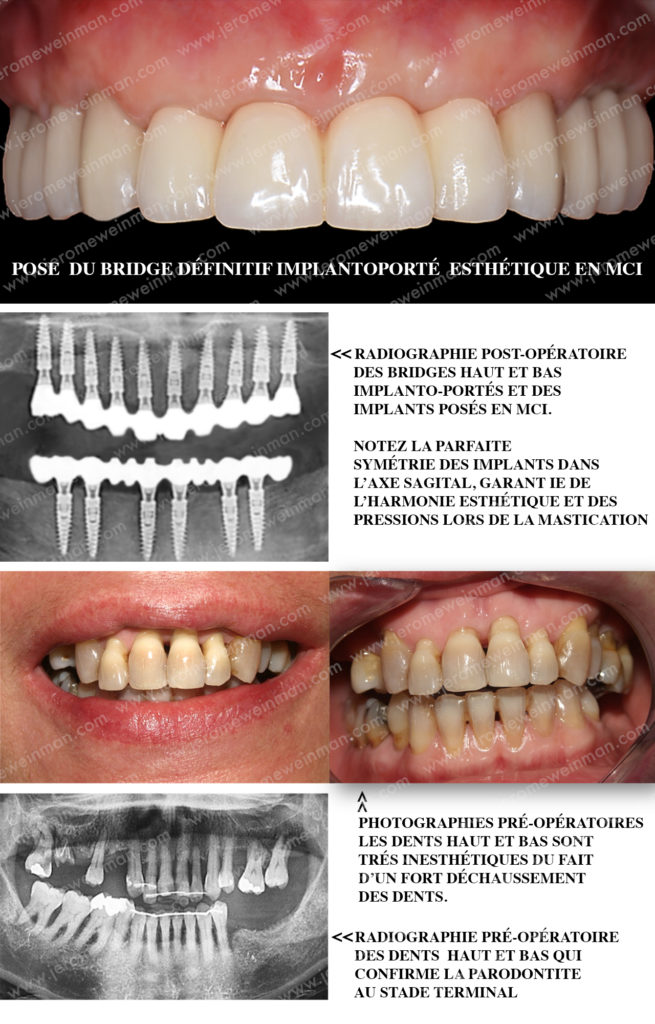 Le remplacement des dents grâce à une Mise en charge immédiate des implants dentaires par une prothèse cosmétique implanto-portée de prémolaire droite à prémolaire gauche pour un nouveau sourire en quelques jours, par le docteur Jérôme Weinman chirurgien dentiste à Paris et médecin dentiste à Genève.