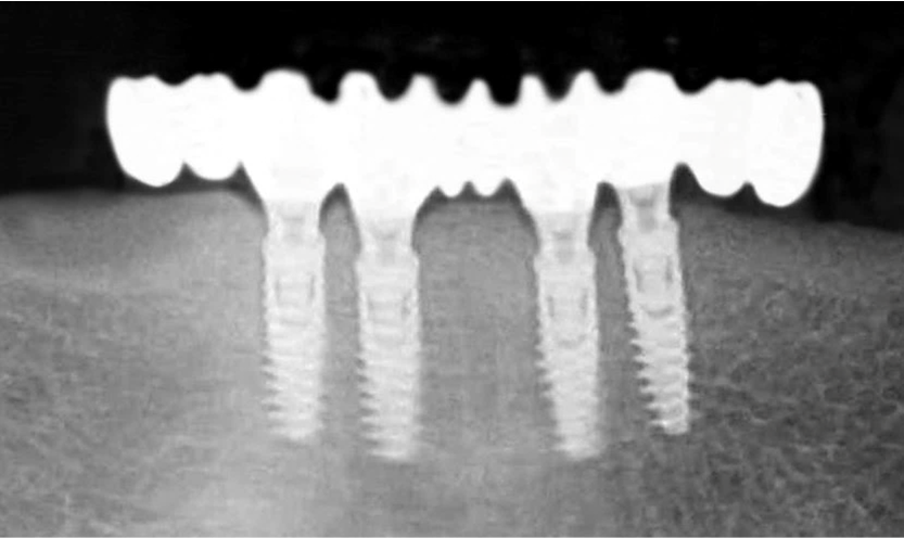 Ici la radiographie d'un All on 4 à la mandibule. Voyez que l'arcade remplacée est restreinte aux prémolaires en extension sur le bridge