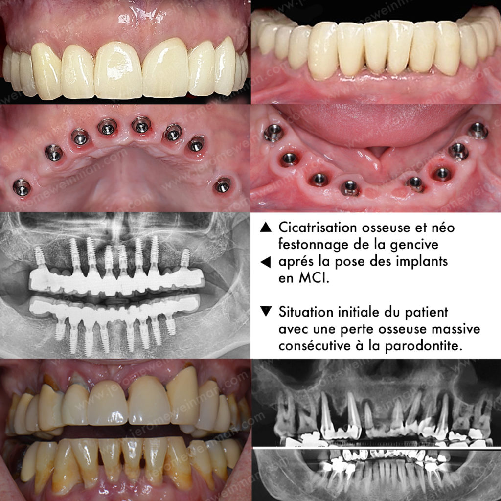 Comment remplacer toutes les dents par des implants dentaires en Mise en Charge Immédiate (MCI) grâce à une prothèse cosmétique implanto-portée et avoir un nouveau sourire en quelque jours, par le docteur Jérôme Weinman chirurgien dentiste à Paris et médecin dentiste à Genève?