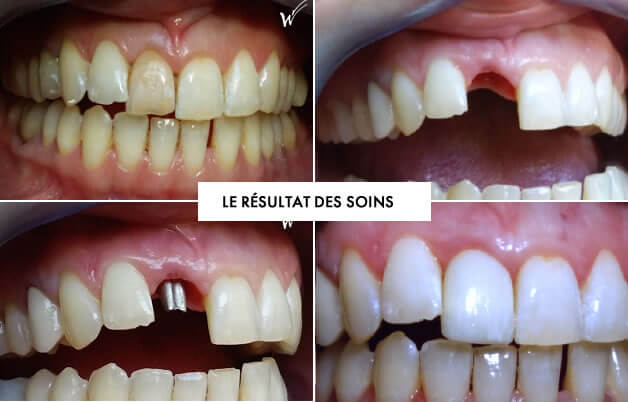 Couronne dentaire en Céramique (tout savoir sur ces prothèses)Dr Jérôme  Weinman chirurgien-dentiste Paris & médecin-dentiste Genève